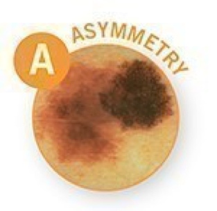 Melanoma
