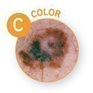 Melanoma