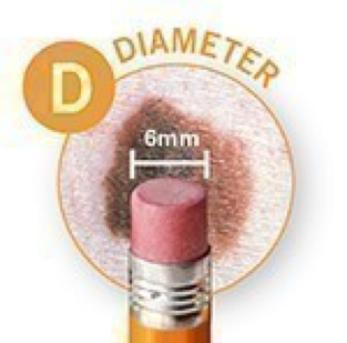 Melanoma